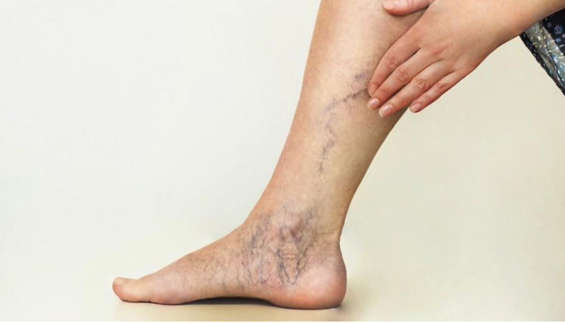 Understanding Venous Insufficiency: Causes, Symptoms, and Treatment